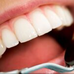 وصفات منزلية لعلاج تسوس الأسنان والتخفيف من آلامها